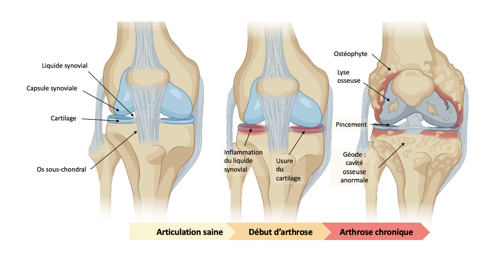 Schéma évolution arthrose